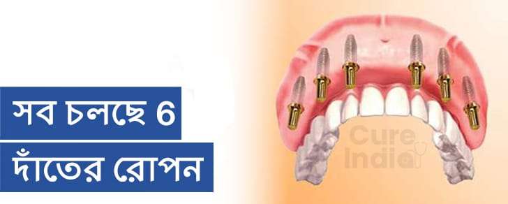 সমস্ত 6 ডেন্টাল ইমপ্লান্টে
